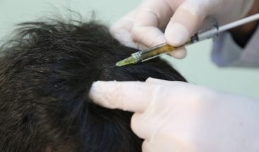 Cumhuriyet Üniversitesi bu yöntemle kelliği önleyecek