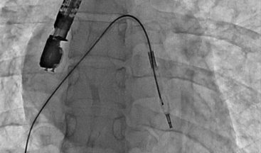 Mitral balon operasyonu adım adım kaydedildi