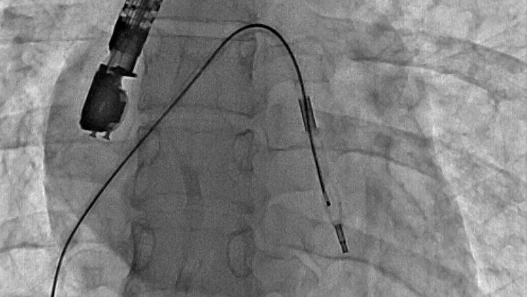 Mitral balon operasyonu adım adım kaydedildi