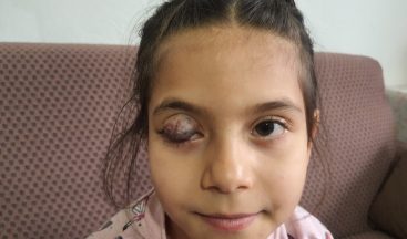 Göz kapağında doğuştan tümör bulunan 7 yaşındaki Beyza’nın yardım çığlığı