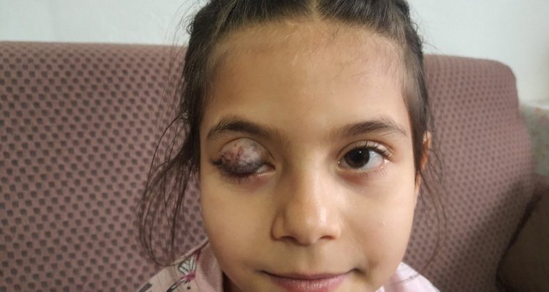 Göz kapağında doğuştan tümör bulunan 7 yaşındaki Beyza’nın yardım çığlığı