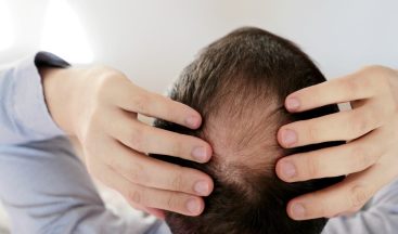 Saçları korona değil stres döküyor