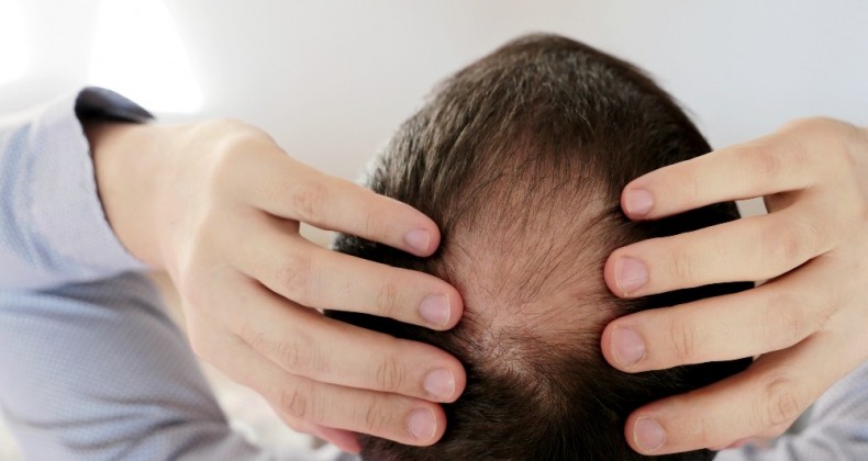 Saçları korona değil stres döküyor