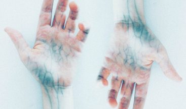 “Zümrüt lazeri ince kılcal damarlı varislerde tedavisinde kullanıyoruz”