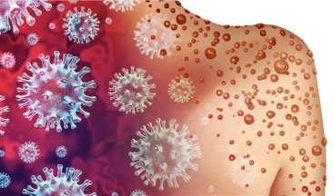 İletişim Başkanlığı’ndan Maymun Çiçeği (Monkeypox) Açıklaması